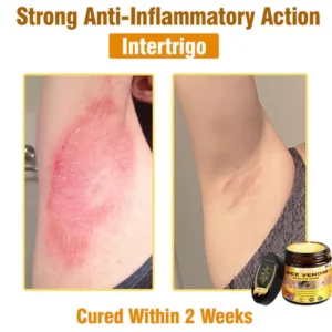 𝐁𝐞𝐞 𝐕𝐞𝐧𝐨𝐦 𝐀𝐥𝐥-𝐢𝐧-𝐎𝐧𝐞 𝐂𝐫𝐞𝐚𝐦–🌸 Anti-aging,Hydrating, Skin Repair, Even Tone, Acne and Dark Spot Treatment, Wart and Mole Removal, Psoriasis Relief - Image 13