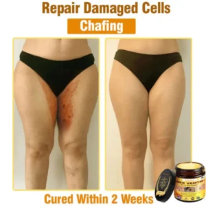 𝐁𝐞𝐞 𝐕𝐞𝐧𝐨𝐦 𝐀𝐥𝐥-𝐢𝐧-𝐎𝐧𝐞 𝐂𝐫𝐞𝐚𝐦–🌸 Anti-aging,Hydrating, Skin Repair, Even Tone, Acne and Dark Spot Treatment, Wart and Mole Removal, Psoriasis Relief - Image 8