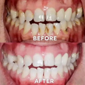 Fluoride-Free Nano Hydroxyapatite Tooth Powder - Image 4