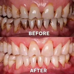 Fluoride-Free Nano Hydroxyapatite Tooth Powder - Image 5