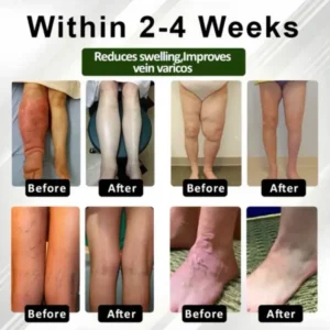 Leg Therapy Edema Cream - Image 3