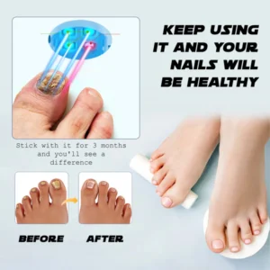 Ricpind NailFungal CleaningLaser TherapeuticDevice - Image 2