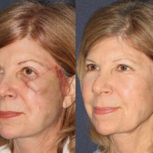 Scar Silicone Scar Gel - Image 5