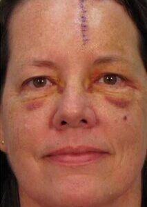 Scar Silicone Scar Gel - Image 9