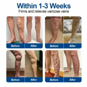 VeinEase Microneedle Care PatchInstant Relief, Long-Term Results - Image 3