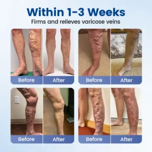 Vein Ease Microneedle Therapy Patch - Image 10