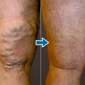 VenoAid Varicose Solution Spray - Image 5