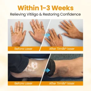 VitiGone Rapid Spray — 2–3 Week Repigmentation with OTDS - Image 5