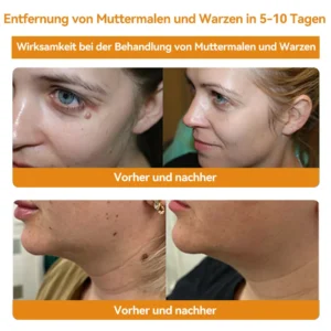 Bienengift Waren & Muttermalenfernung Creme - Image 12