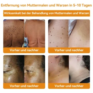 Bienengift Waren & Muttermalenfernung Creme - Image 5