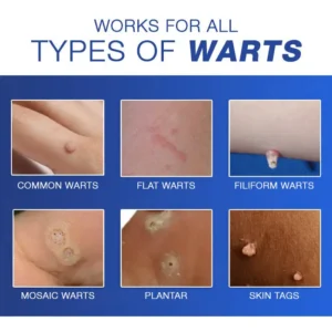 🔥Warts No More - 50% OFF | Wart Eraser Pro - Image 6