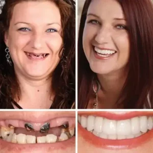 Medical Full Denture with Strong Suctiond - Image 10