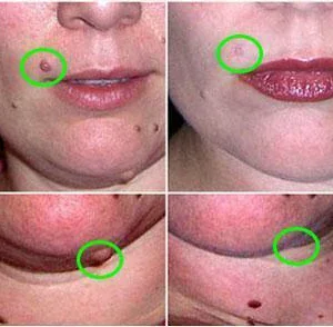 Mole & Skin Tag Removal Solution - Image 2