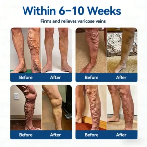 𝐕𝐞𝐢𝐧 𝐂𝐨𝐧𝐭𝐨𝐮𝐫 𝑪𝒍𝒊𝒏𝒊𝒄𝒂𝒍-𝑮𝒓𝒂𝒅𝒆 𝑭𝒐𝒓𝒎𝒖𝒍𝒂 𝑴𝒊𝒄𝒓𝒐𝒏𝒆𝒆𝒅𝒍𝒆 𝑷𝒂𝒕𝒄𝒉 - Image 2