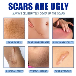 Alcuras Medical Grade Silicone Scar Cream - Image 4