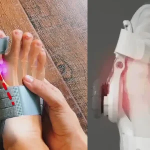 Non-Surgical Relief for Bunion Pain - Image 4