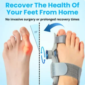 Non-Surgical Relief for Bunion Pain - Image 6