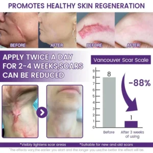 ReGenScar Rapid Recovery Scar Gel - Image 3