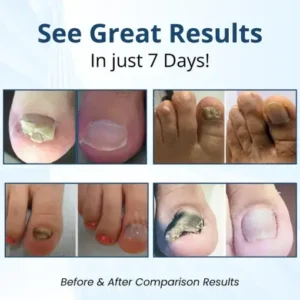 Pro Fungal Nail Patches - Image 2