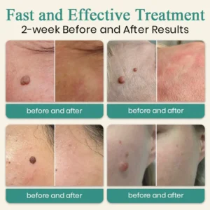Mole and Wart Instant Removal Laser Pen - Image 2