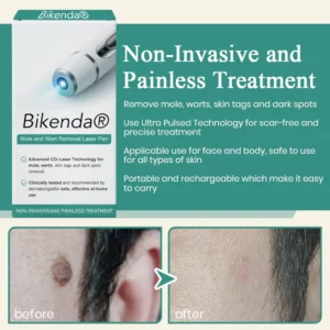 Mole and Wart Instant Removal Laser Pen - Image 4