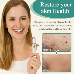 Mole and Wart Instant Removal Laser Pen - Image 6