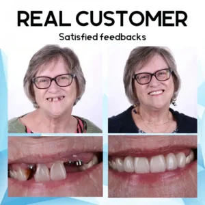 Silicone Reline Denture Set - Image 6