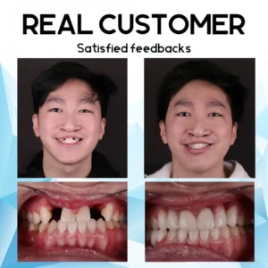 Silicone Reline Denture Set - Image 7