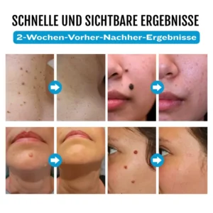 SpotlessDerm Molen- und Warzen-Laserstift - Image 4