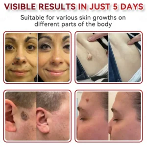 Microneedles Botanical Skin Tags Solution Patches - Image 4