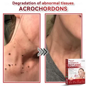 Microneedles Botanical Skin Tags Solution Patches - Image 5