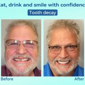 Premium Denture AdaptableFit Functional Dentures - Image 10