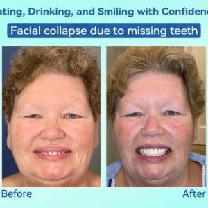 Premium Denture AdaptableFit Functional Dentures - Image 13