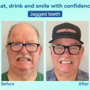 Premium Denture AdaptableFit Functional Dentures - Image 9