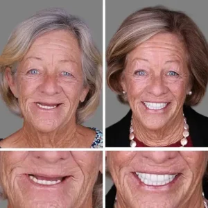 Medical Full Denture with Strong Suctiond Custom-Fit Full Functional Dentures - Image 11