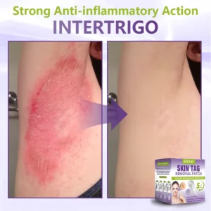 Soluble Microneedle Botanical Skin Tag Removal Patch - Image 11