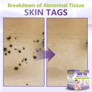 Soluble Microneedle Botanical Skin Tag Removal Patch - Image 4