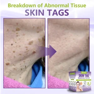 Soluble Microneedle Botanical Skin Tag Removal Patch - Image 5