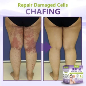 Soluble Microneedle Botanical Skin Tag Removal Patch - Image 6
