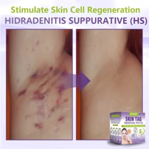 Soluble Microneedle Botanical Skin Tag Removal Patch - Image 9