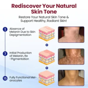 Rapid Repair Vitiligo Essence - Image 2
