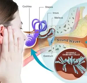 Tinnitus Treatment Ear Patch - Image 3
