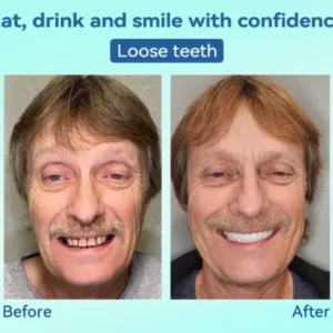 Premium Denture AdaptableFit Functional Dentures - Image 10