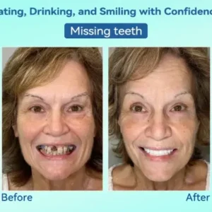 Premium Denture AdaptableFit Functional Dentures - Image 11