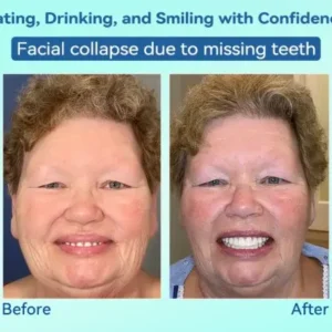 Premium Denture AdaptableFit Functional Dentures - Image 12