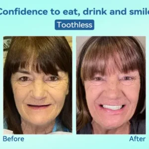 Premium Denture AdaptableFit Functional Dentures - Image 6