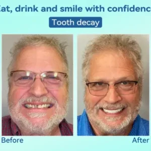 Premium Denture AdaptableFit Functional Dentures - Image 9