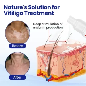 Vitiligo Repigmentation Spray - Image 3