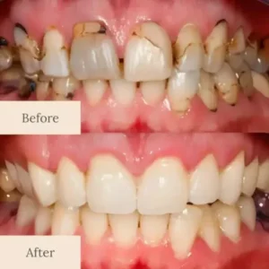 Advanced Enamel Repair & Whitening Kit - Image 7