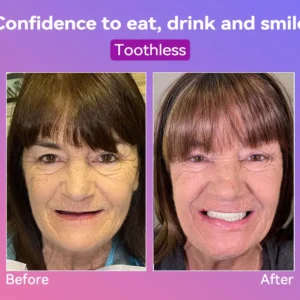 Latest Premium Comfort Dentures - Image 10